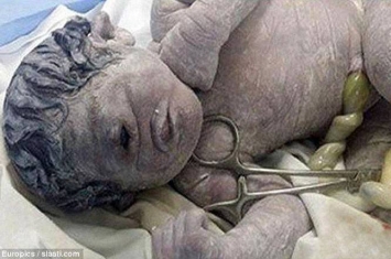 埃及妇女子宫疑曝露辐射诞独眼畸形男婴