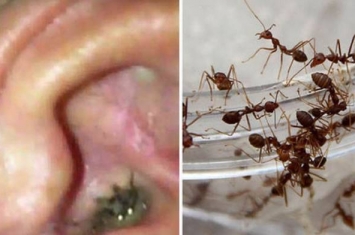 印度12岁女童耳朵成蚂蚁窝 每日爬出15只