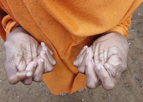 印度“女巫”有31根手指和脚趾，毛骨悚然背后还有痛心