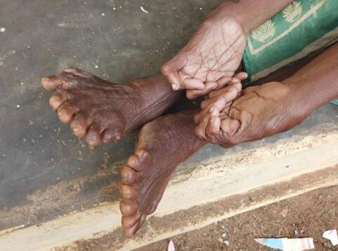 印度“女巫”有31根手指和脚趾，毛骨悚然背后还有痛心