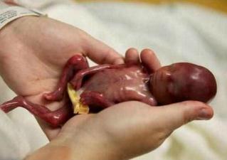 世界上最小的婴儿只有24cm长，揭秘阿米利娅·泰勒现状怎样