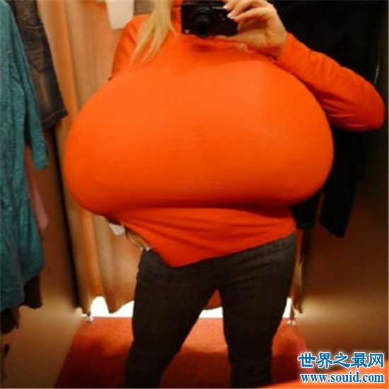 世界上最大的天然乳房，双乳重达77斤（图）