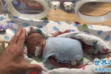 最小存活婴儿出院怎么回事，惊掉医学天才的下巴