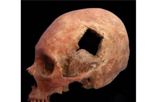 印加人在5000年前就拥有了开颅手术的技术?他们是怎么做到的?