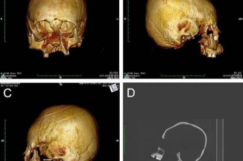 考古学家对克罗地亚奥西耶克市考古遗址2013年出土的怪异人类头骨进行研究