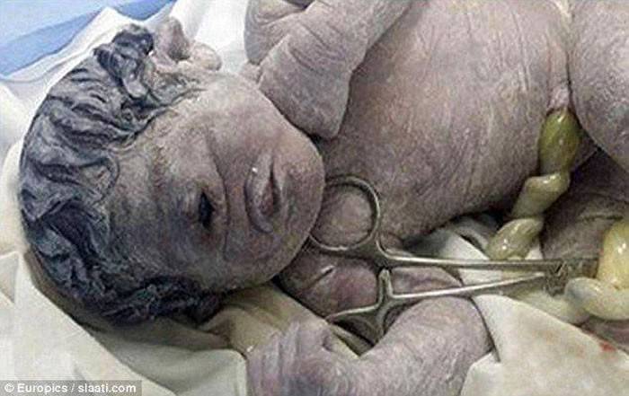 埃及妇女子宫疑曝露辐射诞独眼畸形男婴