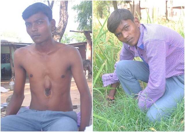 印度18岁男青年心脏长在肋骨外 无阻生活正常工作