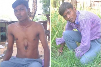 印度18岁男青年心脏长在肋骨外 无阻生活正常工作