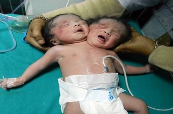 孟加拉诞生极为罕见的“双头女婴” 数千村民跑到医院朝圣