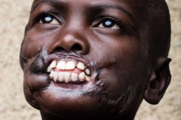 刚果男童遭黑猩猩袭击 失上下唇被朋辈歧视