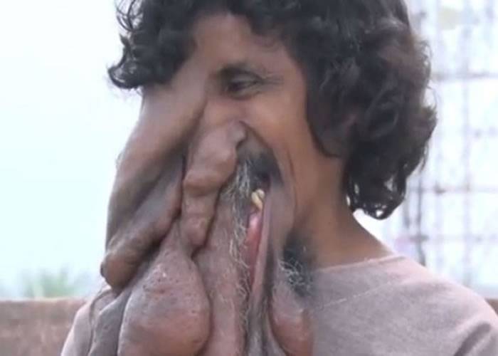 印度男子Kanai Das患罕见疾病右脸长巨瘤似“象人”