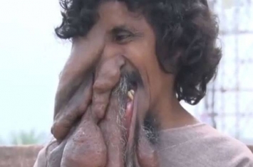 印度男子Kanai Das患罕见疾病右脸长巨瘤似“象人”