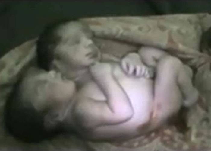印度北方邦一名母亲诞下双头婴 出生不足两天死亡