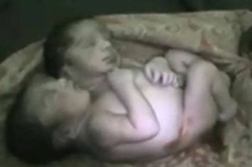 印度北方邦一名母亲诞下双头婴 出生不足两天死亡