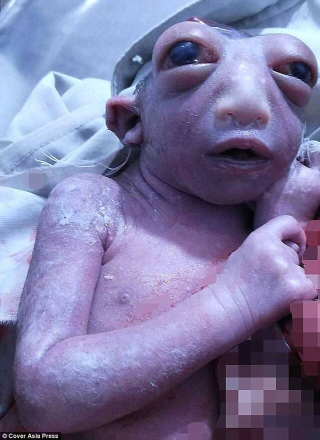 印度北方邦32岁妇人诞下“外星人”：只有半个头、双眼巨大突出的女婴