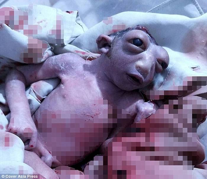 印度北方邦32岁妇人诞下“外星人”：只有半个头、双眼巨大突出的女婴