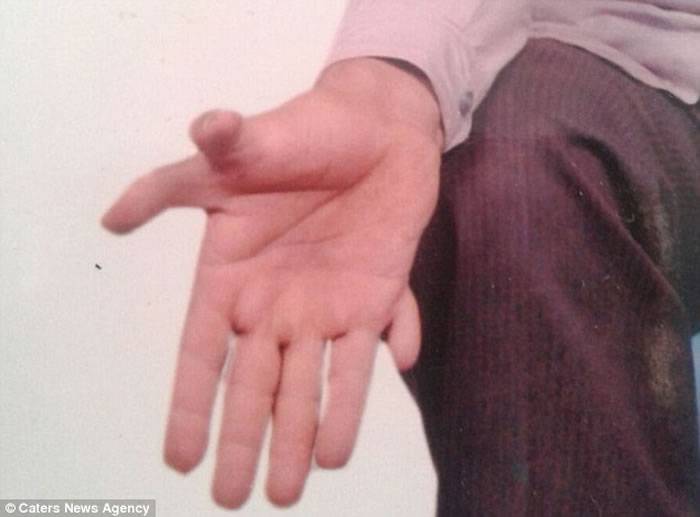 全世界最多手指脚趾的人：印度男子Devendra Sutha总共有28个手指与脚趾