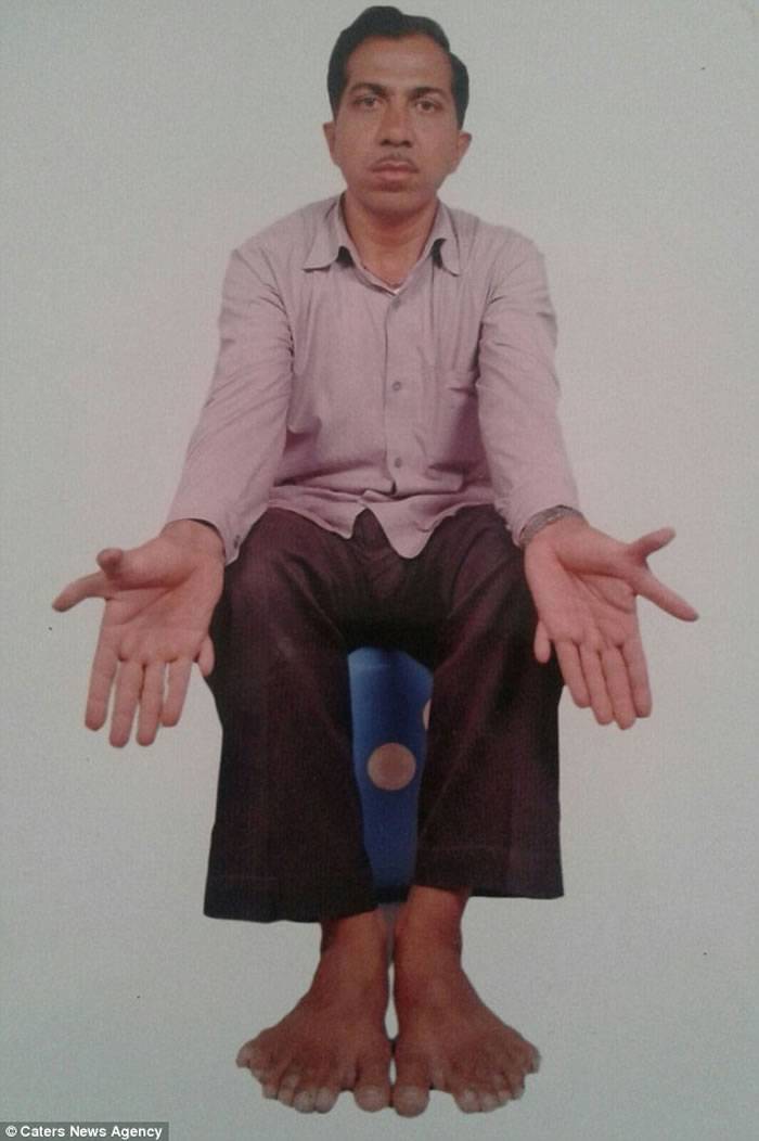 全世界最多手指脚趾的人：印度男子Devendra Sutha总共有28个手指与脚趾