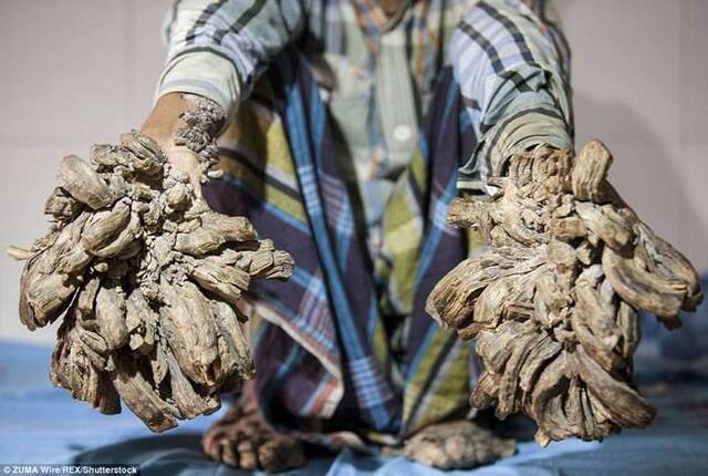 孟加拉男子Abul Bajandar患罕见皮肤病 手脚长出树根状的疣