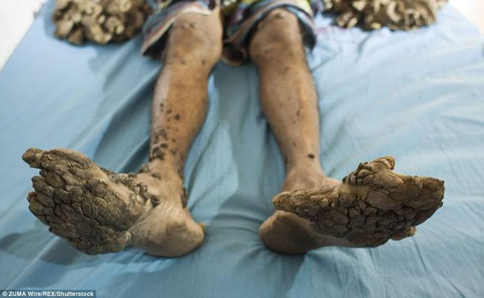 孟加拉男子Abul Bajandar患罕见皮肤病 手脚长出树根状的疣