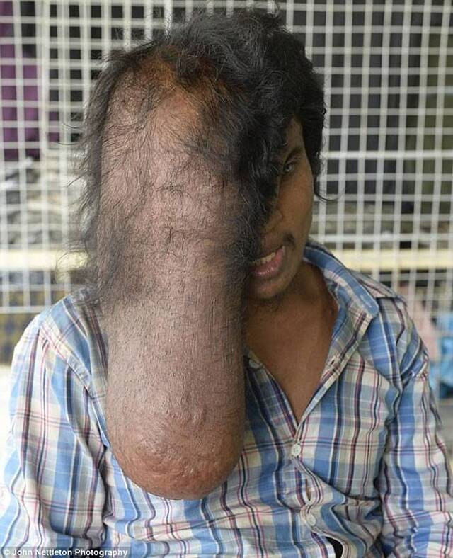 柬埔寨男子Vid脸部长巨瘤如“象人”