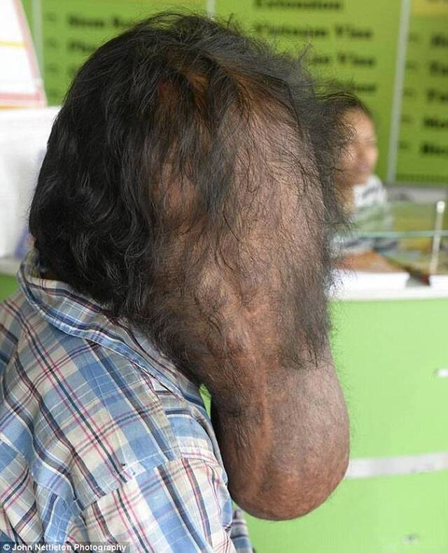 柬埔寨男子Vid脸部长巨瘤如“象人”
