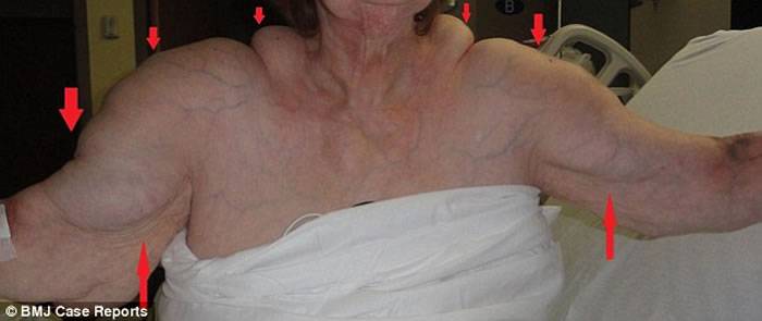 英国64岁妇人酗酒40年背部长“驼峰” 患上罕见马德龙病（Madelung disease)