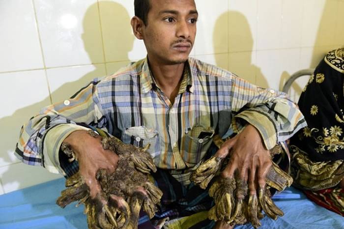 孟加拉“树人”Abul Bajandar除疣手术成功