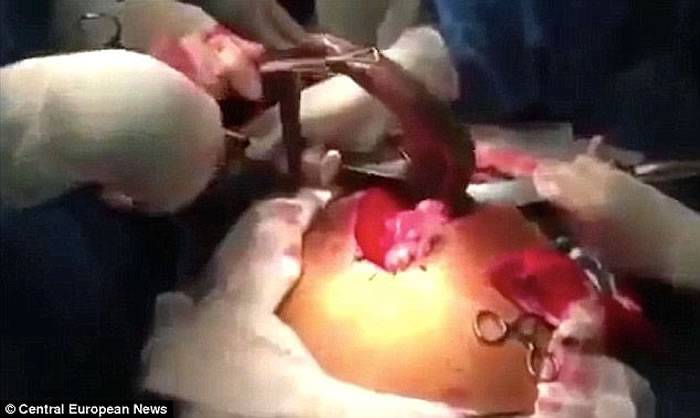 马来西亚男子异物卡喉 最后医生从喉咙拉出一条仍在挣扎的活鱼“攀鲈”