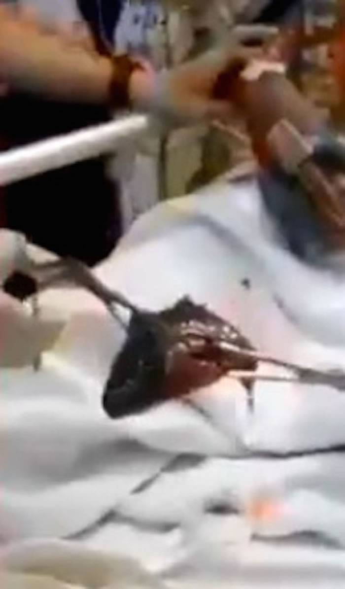 马来西亚男子异物卡喉 最后医生从喉咙拉出一条仍在挣扎的活鱼“攀鲈”