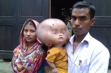 孟加拉2岁大男童出现严重脑水肿 头部犹如外星人