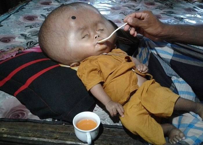 孟加拉2岁大男童出现严重脑水肿 头部犹如外星人