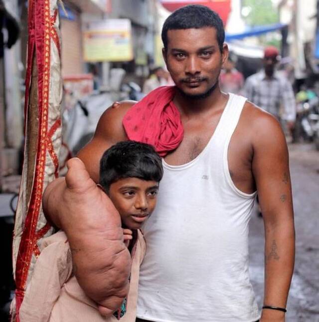 印度25岁男子患巨人症手臂比正常人大两倍 被嘲“魔鬼的孩子”
