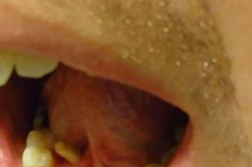 恶心：美国男子拍片分享自行挤出唾液腺结石 犹如一条怪虫