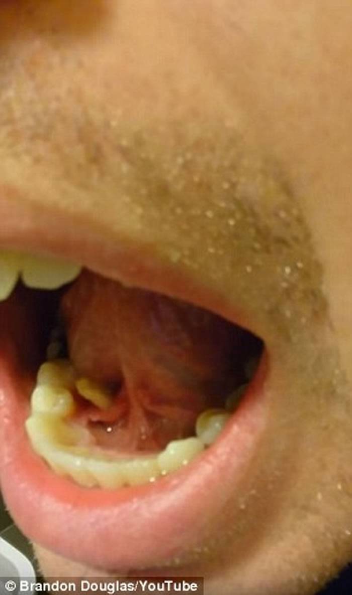 恶心：美国男子唾液腺肿胀流脓牙医说是结石 自己挤出3公分长白色怪虫