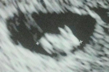 美国佛罗里达州孕妇到医院接受超声波扫描发现腹中胎儿外形似小兔子