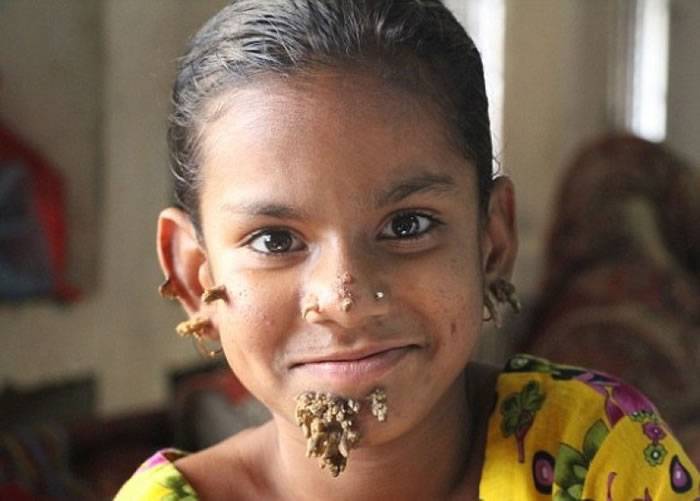 孟加拉“小树人”女童身有缺陷无阻认识朋友