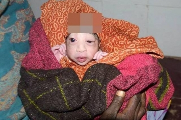 印度女婴头长巨瘤皮肤如鳞 遭母嫌弃拒喂奶