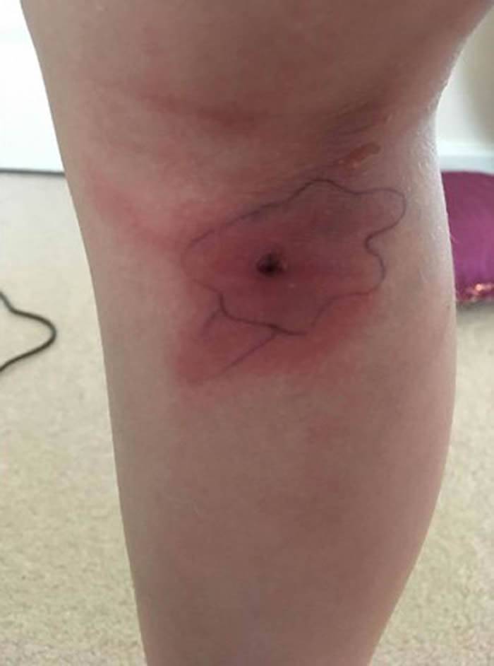 英国8岁女童出现流感症状 伤口爆裂跑出一只蜘蛛