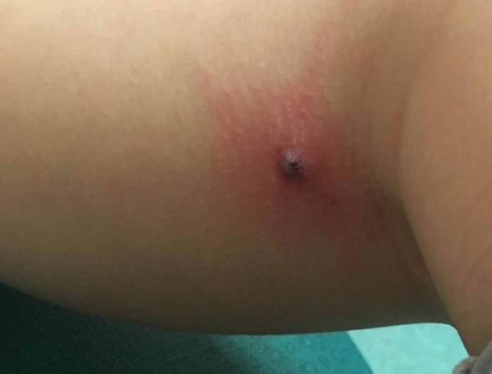 英国8岁女童出现流感症状 伤口爆裂跑出一只蜘蛛