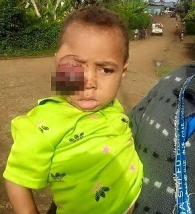 非洲巴布亚新几内亚男童眼瘤大如拳头 家人误信巫医险送命