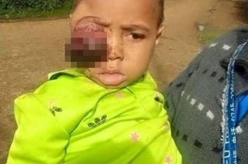 非洲巴布亚新几内亚男童眼瘤大如拳头 家人误信巫医险送命