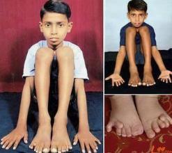 世界上手指最多的人，印度男孩手指脚趾共有34个（与遗传有关）