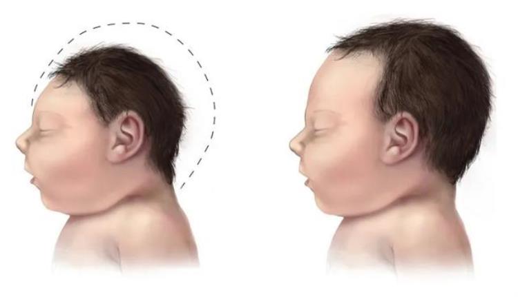 卢旺达一婴儿头部三角形,刚出生的宝宝为什么跟外星人很像