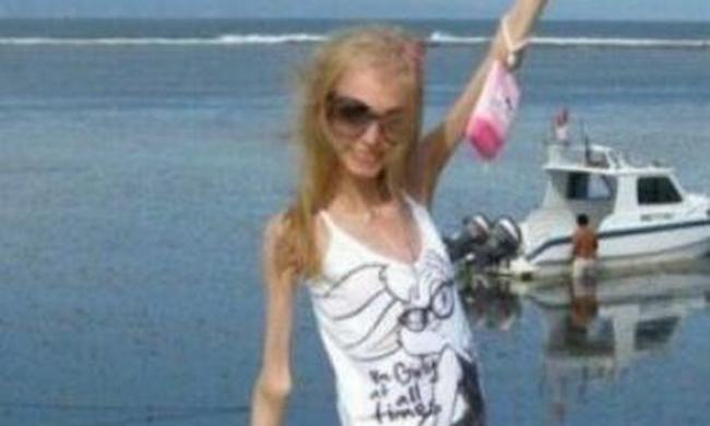 瘦成干尸的少女 俄罗斯少女因厌食症仅为20公斤