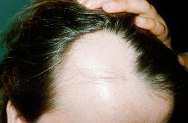 脂溢性脱发症状有哪些?为什么会脂溢性脱发(遗传)