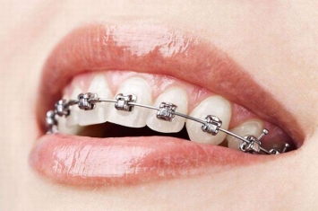 矫正牙齿对以后有影响吗?矫正牙齿利与弊有哪些?