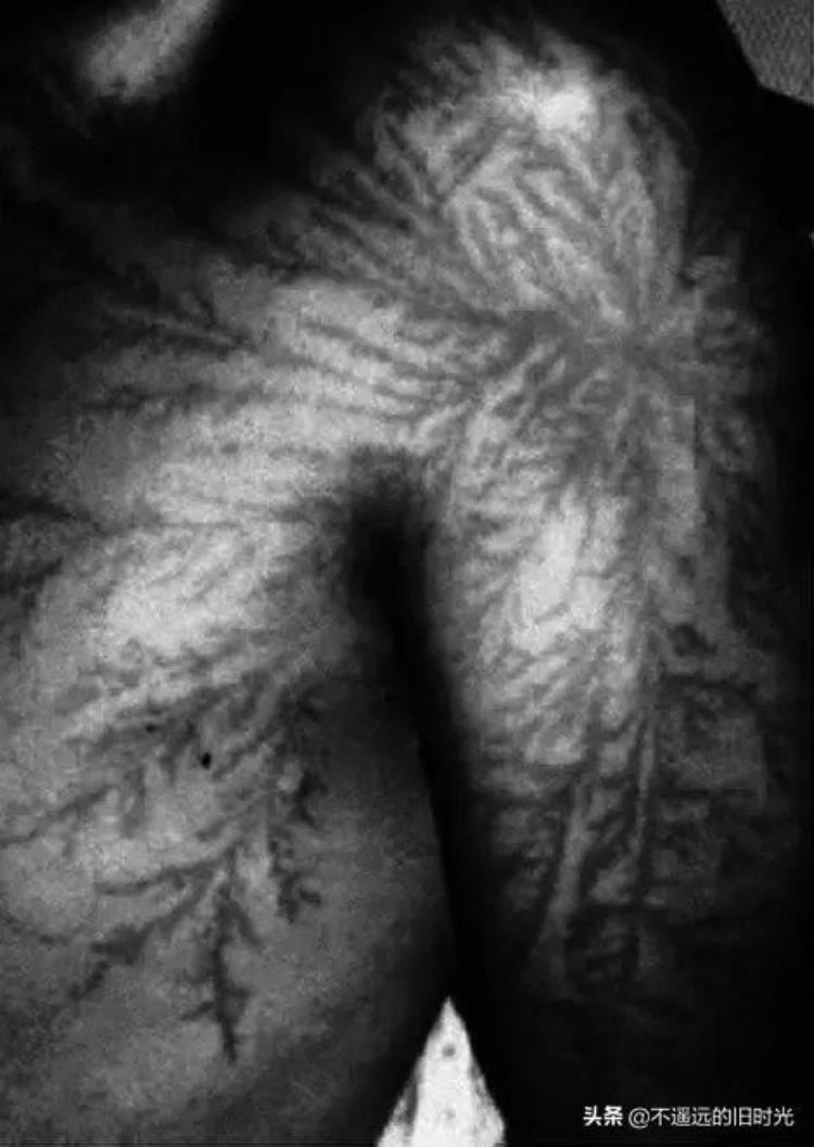 利希滕贝格图腾,被闪电击中留下的天然刺青,生命中最恐怖印记之一