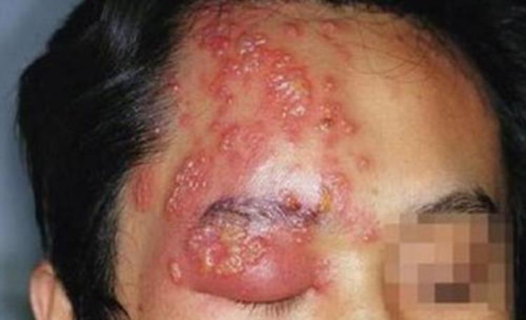 病毒性感染的皮肤病,又痒又疼传染性极强的皮肤病