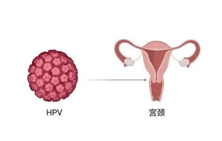 hpv是如何引发癌症的,hpv病毒引起的癌症有哪些